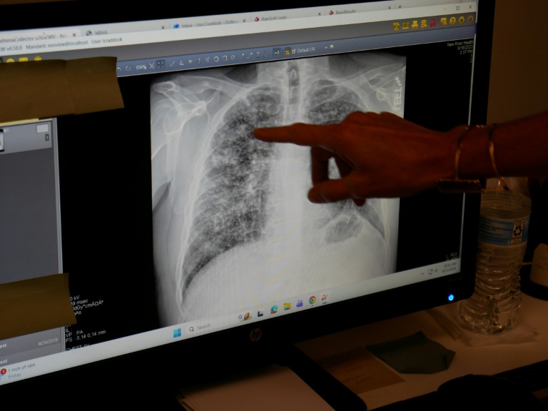 Lisa Emery, directrice du Breathing Center and Black Lung Clinic; montre une radiographie des poumons d'un mineur de charbon souffrant de pneumoconiose, le 13 août 2026 au New River Health, à Oak Hill, en Virginie-Occidentale 