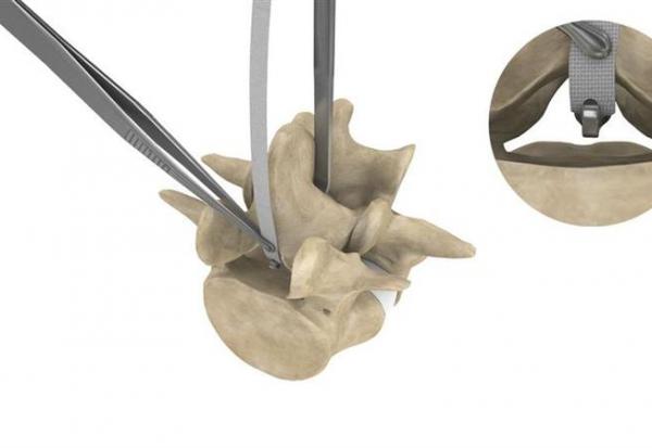 Implanet : premières poses du système JAZZ en Chine