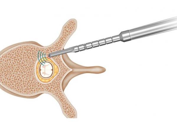 SpineGuard et Omnia Medical annoncent la conclusion du transfert des actifs de SpineGuard Inc.